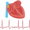 Don’t Ignore an Irregular Heartbeat