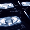 Understanding Prostate Cancer and Your Risk